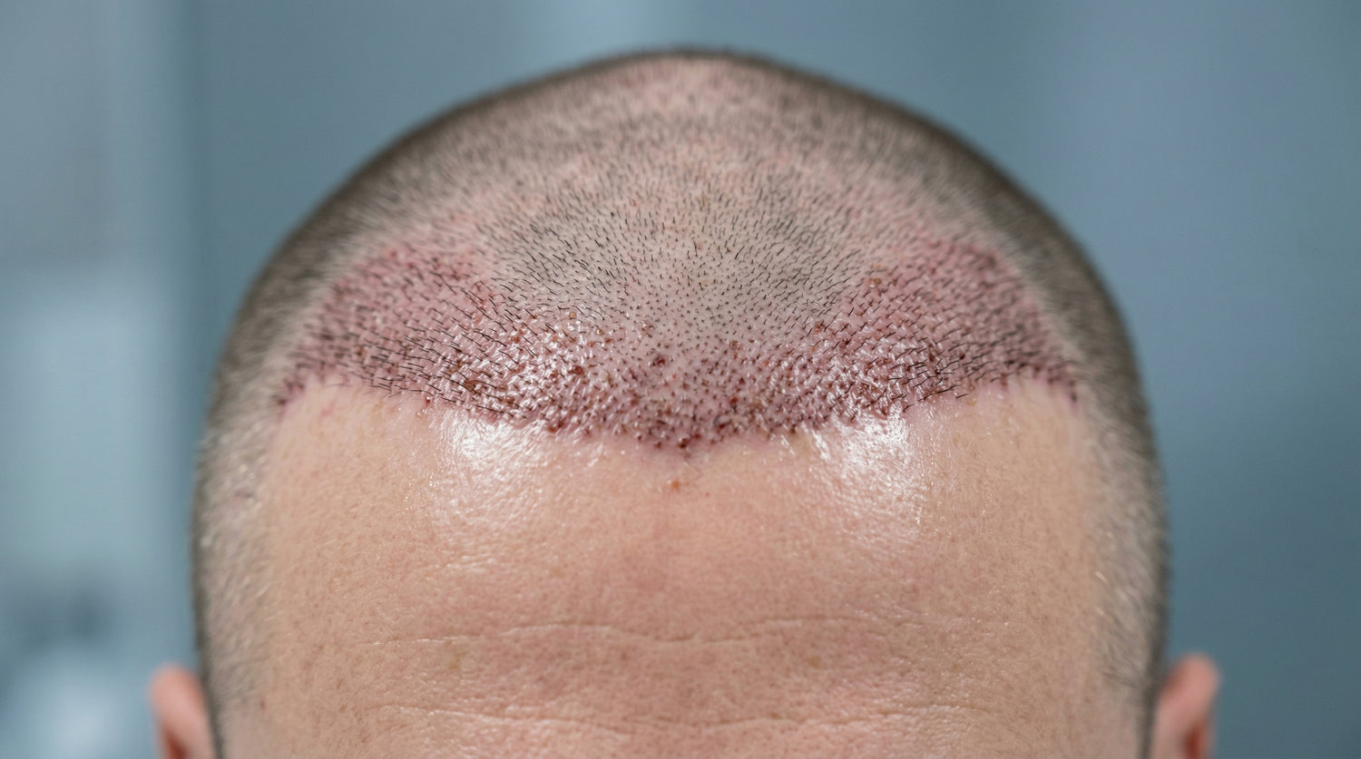 Sac ekimi sonrasi bakim - Viven Hair dermatolojik urunler